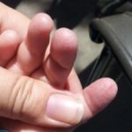 Сухая кожа на руках и ногах — причины